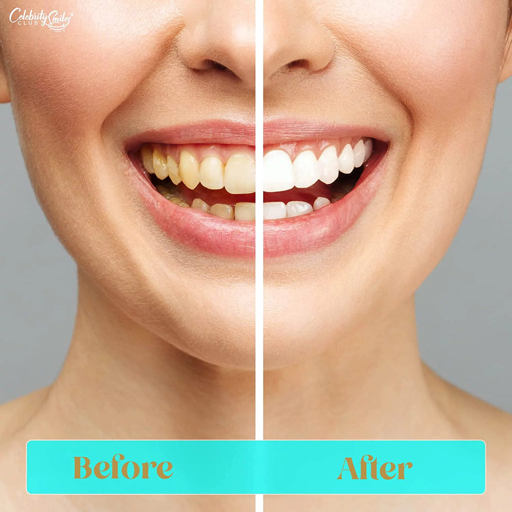 Teeth Whitening Kit with LED Lights and Gel Pens B867