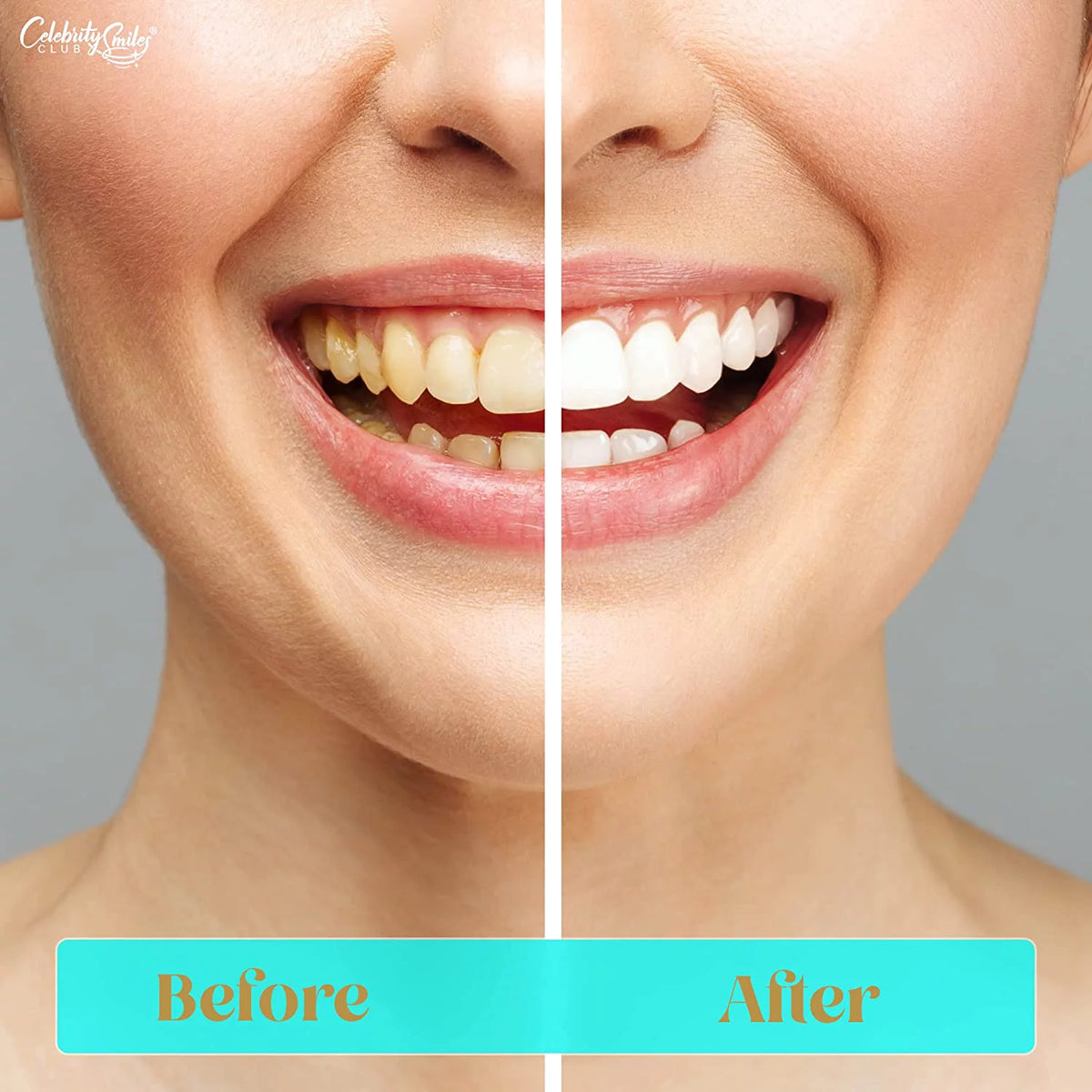 Teeth Whitening Kit with LED Lights and Gel Pens B867